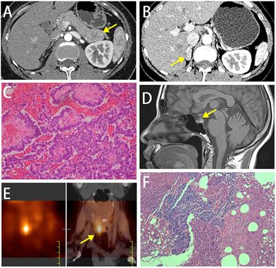 Ultrasound-guided microwave ablation in the treatment of recurrent primary hyperparathyroidism in a patient with MEN1: a case report